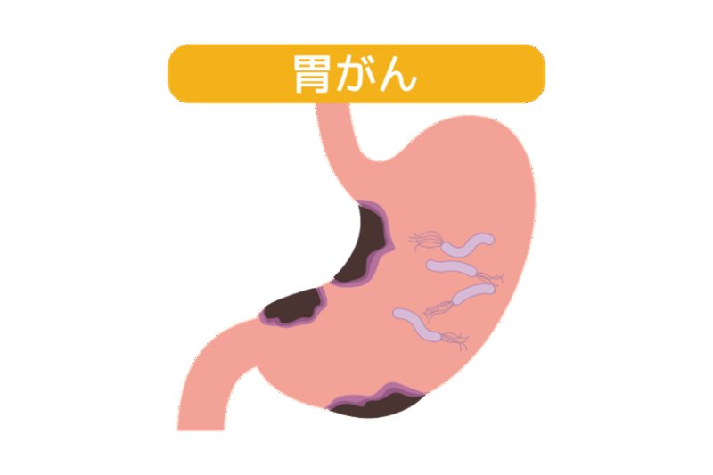 【医師監修】胃がんの初期症状と原因｜早期発見のために知っておくべきことのアイキャッチ画像