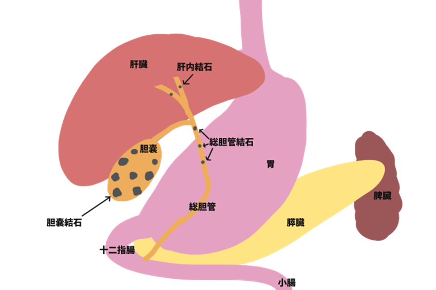 【医師監修】右脇腹の痛み、それ胆のう炎かも?胆石との関係と治療法を解説 - さいとう内科クリニックブログ
