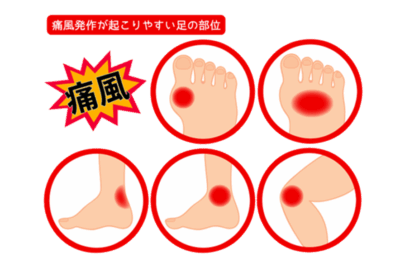 「風が吹かなくてもいてーよ!」タレント古坂大魔王さんも経験した、痛風発作の激痛と本当に怖い合併症のアイキャッチ画像