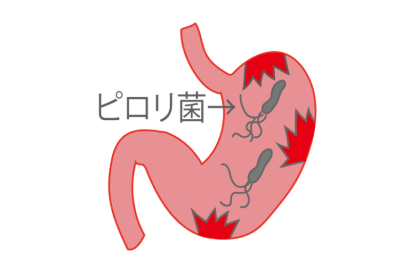 ピロリ菌検査は「保険適用」になる？実は「胃カメラ」が必須条件です。費用と検査の仕組みについてのアイキャッチ画像
