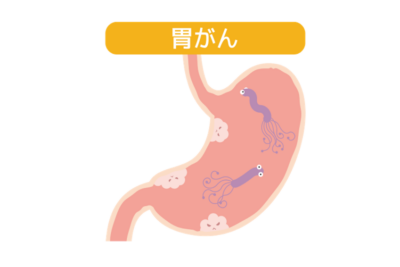 【胃がん原因の99%】ピロリ菌は「1週間の飲み薬」で退治できます。自分と家族を守るために知っておくべきことのアイキャッチ画像